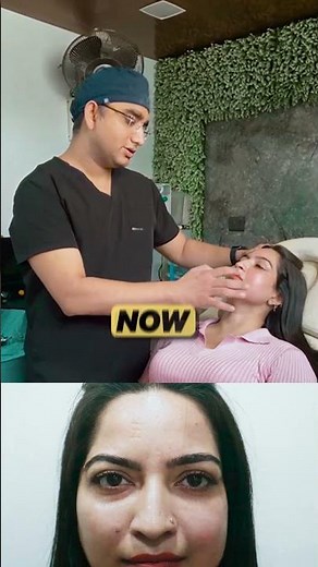 Face fat Grafting