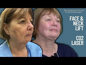 FACE & NECK LIFT | CO2 LASER - Serious Results