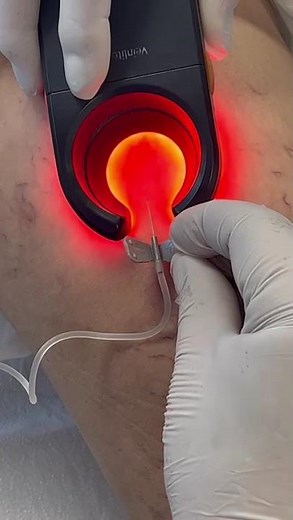 Dr. Alejandro Cabrera uses Veinlite LEDX for sclerotherapy treatment