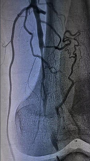 Thromboctomy#PoplitealArtery #Thrombectomy #PeripheralAngioplasty #CathLab #InterventionalRadiology