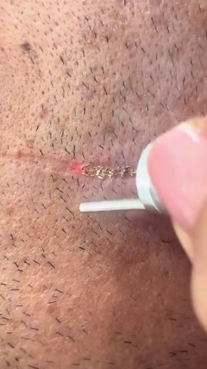 Laser skin treatment is a procedure for skin concerns. Explore more to understand how it works and what it involves. | Beyond Basics