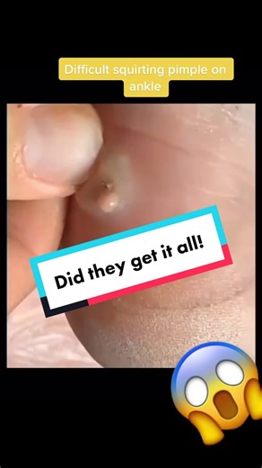 Didficult squirting pimple on heal. #pimplepopping #cystexplostion #blackheadrrmovals #dilatedpores #cystpopping #oddlysatisfying #ingrownhair