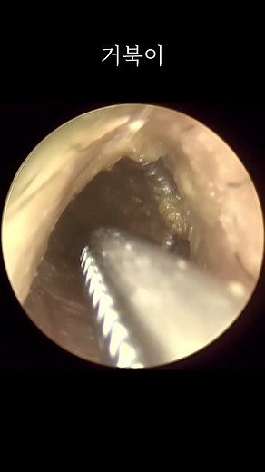 Ear wax plug fell out: what to expect and aftercare