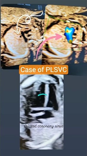 Persistent Left Superior VenaCava (PLSVC) on fetal ultrasound-significance #fetalmedicine#ultrasound