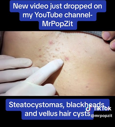 New video just dropped MrPopZit on YouTube. I clear out clogged pores on the chest, patient is so relieved. #medicaleducation #dermatology #mrpopzit #mrpopzitlive #skincare #youtube #youtuber #popaholic #acnetreatment #acneskin #extractions #physicianassociate #skin #acne #steatocystoma