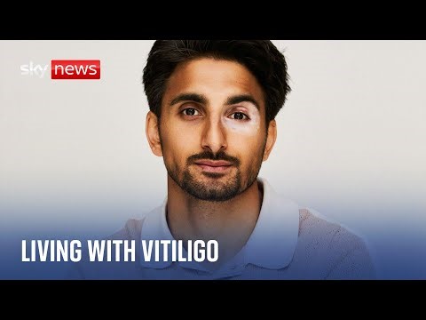 Two-thirds of those with skin condition vitiligo struggle with mental health