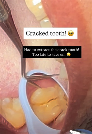 Prevent Tooth Damage: Detect Cracks Early