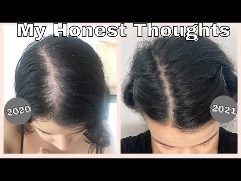 Minoxidil 1 Year Update | does minoxidil work? | Female Hair Loss