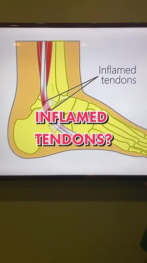 Effective Peroneal Tendinitis Treatment Methods