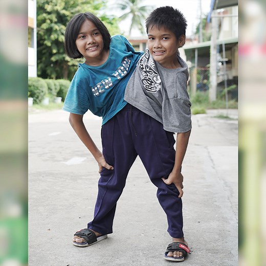 Conjoined twin sisters Pan and Pin are joined from their hips down - meaning they share one pair of legs | Born Different