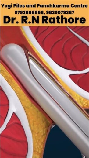 Piles Laser Surgery Treatment | 3D Animation | #shorts