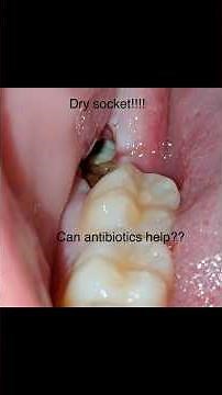 Pain after removing wisdom teeth?? Dry socket aa!!