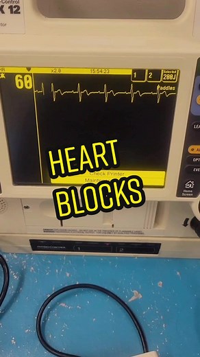 Heart blocks explained. Let me know if it helps! #ekg #paramedic #ems #katespadenyhappydance #med #nursing #fyp #foryou