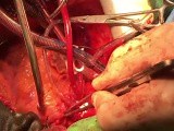 Rapid Sequence Heart Transplant Points and Tricks  • Video • MEDtube.net