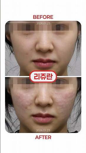 올록볼록 엠보싱 리쥬란✨| 톡스앤필 신논현점