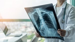 Cancro al polmone: i sintomi iniziali, dalla tosse alla disfonia
