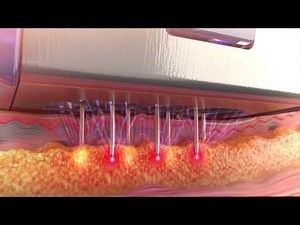 How Does RF Microneedling Work?