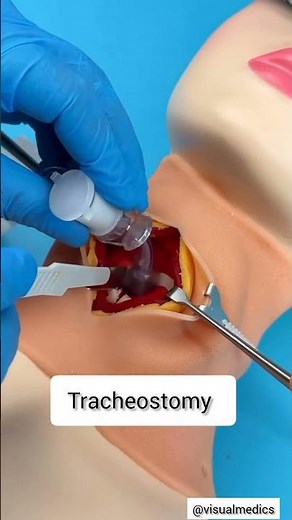 3D model Tracheostomy procedure overview #medicaleducation #medicalanimation #tracheostomy