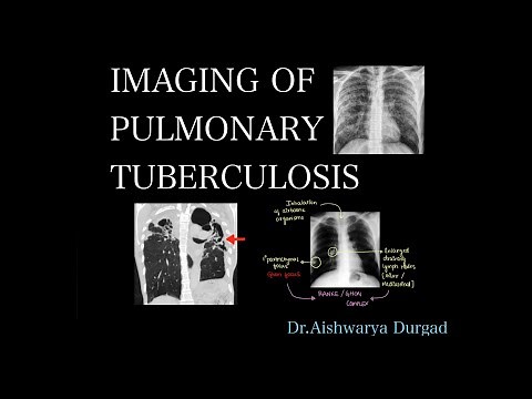 Imaging of pulmonary tuberculosis- A detailed radiologic review | Checklist for reporting |