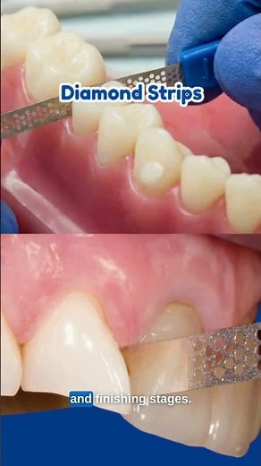 Interproximal Reduction (IPR) for Orthodontics: Diamond Strips vs Rotary Burs