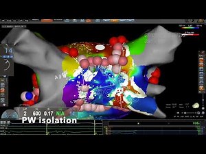 Long-Standing Persistent Atrial Fibrillation Catheter Ablation