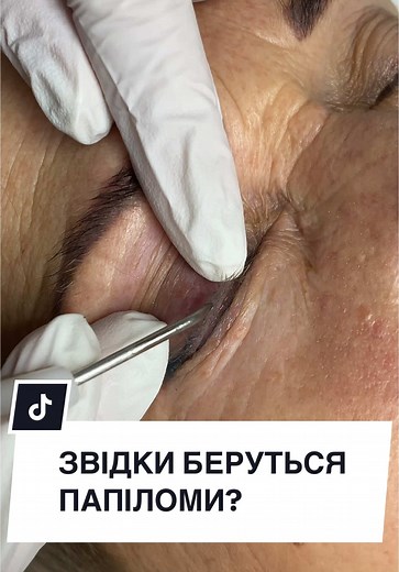 Звідки беруться папіломи? 🤯 #папіломи #вірус #новоутворення #хірургдерматолог