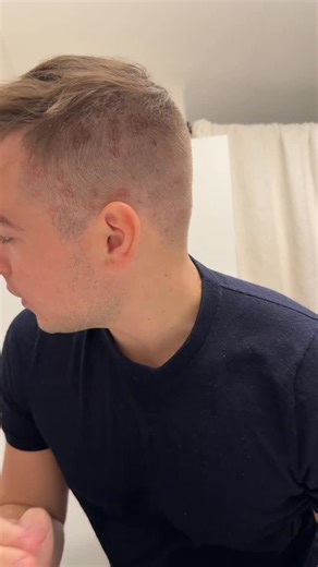 Elliott Norris on Instagram: "Psoriasis update! Looks less irritated/inflamed but not sure if it’s “healing”. I’m currently on Tremfya injections and stopped them for a year and just started back up. I fear my body has now become resistant to the medication."