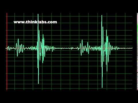 Right Bundle Branch Block- slow