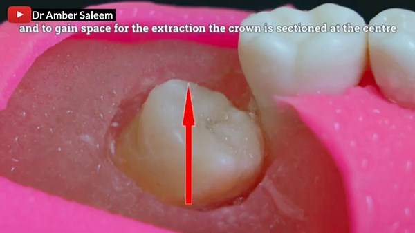 Impacted Wisdom Tooth Removal | Wisdom Tooth Extraction *"Wisdom Tooth Removal Surgery "*Detailed 4k