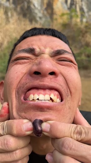 How I Cured a Bug Bite with Yogurtinthe Wild Survival Hacks🥳😱#shorts