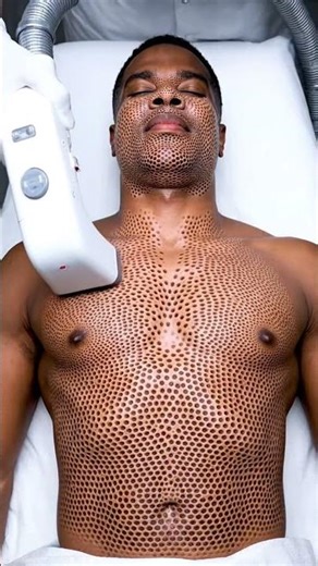 Most Satisfying Blackhead Vacuum Extraction Ever! Real Deep Pore Cleaning ASMR for Stress Relief,