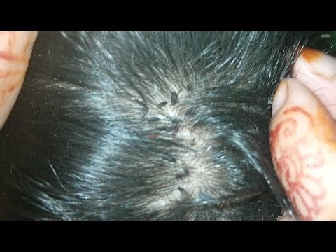 ASMR lices nites removed part 2