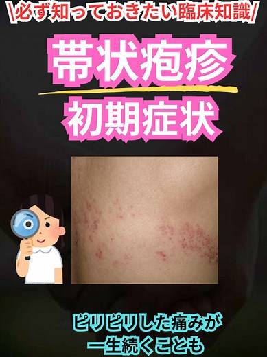 帯状疱疹の初期症状と対策