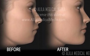 Corrective Jaw (Orthognathic) Surgery, Animation.