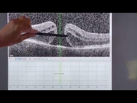 Macular Hole Surgery