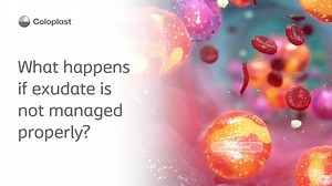 39 reactions · 13 shares | Why is managing exudate so important?...