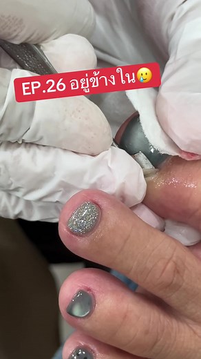 ตัดเล็บขบ วิธีดูแลเล็บขบใน EP.26