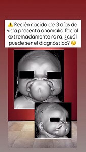 ⚠️ El diprosopus (del griego di = dos, prosopon = rostro) es una anomalía congénita excepcionalmente rara, en la que un mismo cráneo presenta duplicación parcial o completa de la cara. Solo se han descrito alrededor de 36 casos en la literatura médica. 🤰Este caso corresponde a una recién nacida de 3 días, ingresada por sospecha de sepsis neonatal y una malformación facial inusual. Su madre había realizado controles durante su embarazo pero ninguna ecografía. 📚 Al examen físico se observaron do