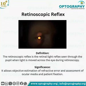 retinoscopy reflex