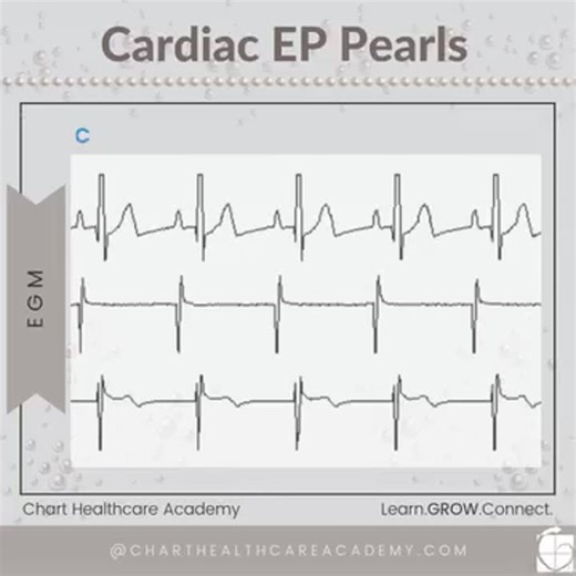 How to Read EP Intracardiac EGMs: Atrial vs Ventricular Signals | CHART Healthcare Academy posted on the topic | LinkedIn