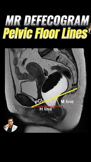Pelvic Floor Lines | MR Defecogram | MR Proctogram |#anatomy #doctor #medical #medicalstudent #MedicalEducation #Radiology #radiographer #radiography #radiologyeducation #radiologylife #CTScan #MRI #medicalimaging #medicaltechnology #MedicalTech #radiologytech #radiologytechnologist | Maruf Bhuiyan The Radiographer