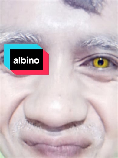 Spotlight on Albinism: Understanding and Embracing Differences