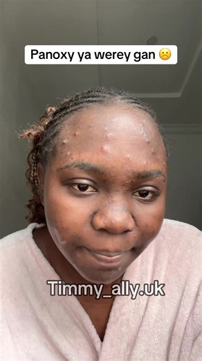 Pimples Drying and Falling Off: Pimple Popping Clips & Acne Care