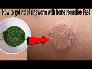 How to get rid of ringworm with home remedies Fast, Ringworm treatment How to itch will get rid