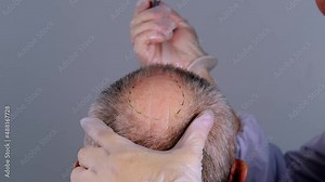 close-up trichologist treats patient, bald mature man with alopecia in hair growth clinic, anti-aging treatments for balding men. concept of hair transplant procedures for men, selective focus