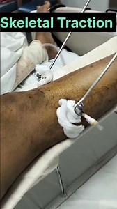 skeletal Traction #ortho #orthopaedicspecialist #physio #yashodamedicity
