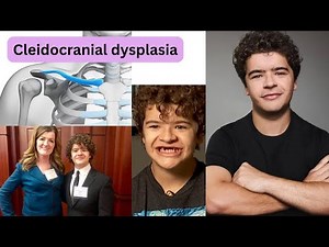 Cleidocranial Dysplasia: Causes, Symptoms, and a Real-Life Example