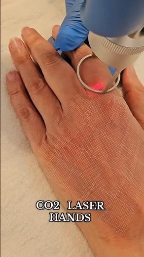 CO2 Laser Hand Rejuvenation: Restore Youth and Smoothness to Your Hands
