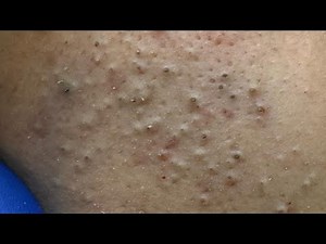 Deep Cleansing Techniques For Acne Prone Skin — Blackhead Removal