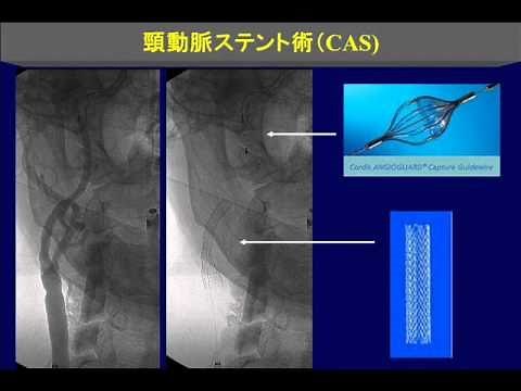 頚動脈ステント術 頸動脈ステント術 （CAS) Carotid artery stenting